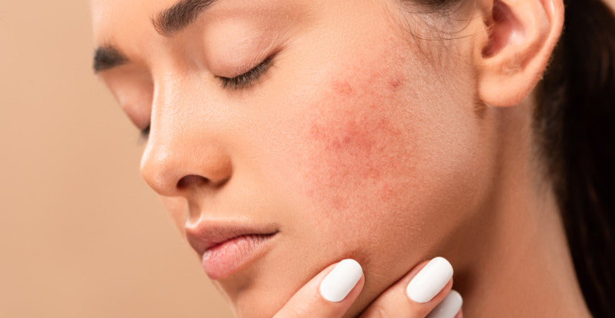 The Impact of Sugar on Your Skin